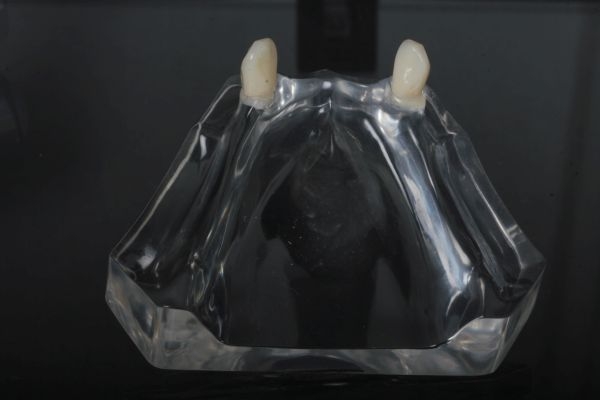 UK-Beratungsmodell transparent Acryl ohne Zahntechnische Arbeit: für Modellgussprothese mit J-Klammern an 2 Zähnen