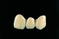 Preview: Metal-ceramic veneer crowns fully veneered in non-precious metal