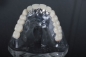 Preview: Titanium veneer crown Upper jaw non visible area with partial ceramic veneer