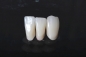 Preview: Bridge made of non-precious metal veneer, for a single tooth gap lower jaw visible area with partial ceramic veneer