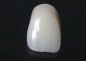 Preview: Metal-ceramic veneer crowns for a single-tooth gap in the upper jaw visible area with full ceramic veneer