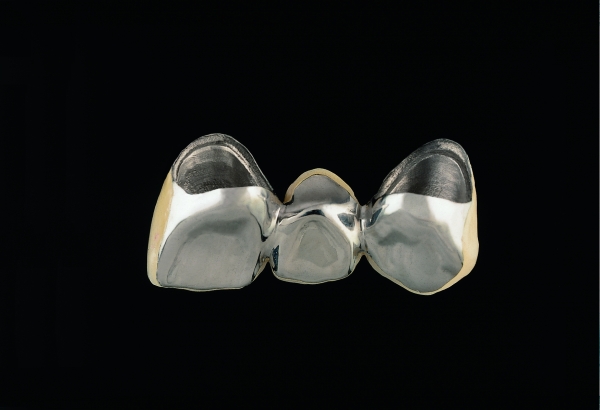 Verblendkrone aus Titan Oberkiefer sichtbarer Bereich mit Teilverblendung aus Keramik