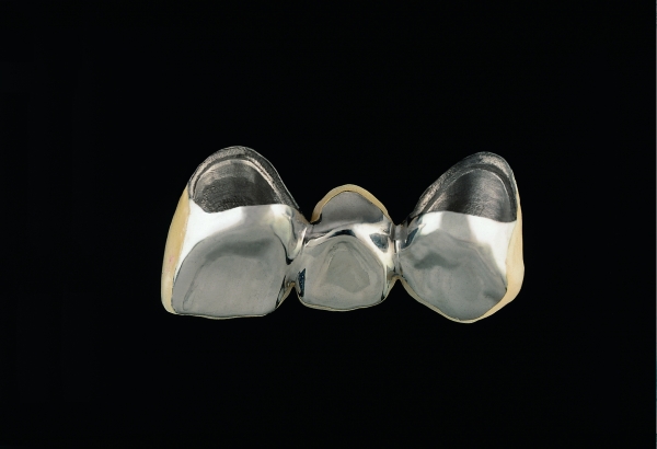 Bridge made of non-precious metal veneer, for a single tooth gap lower jaw visible area with partial ceramic veneer