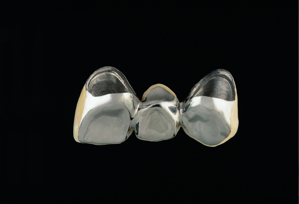 Gold veneer crown with partial ceramic veneer