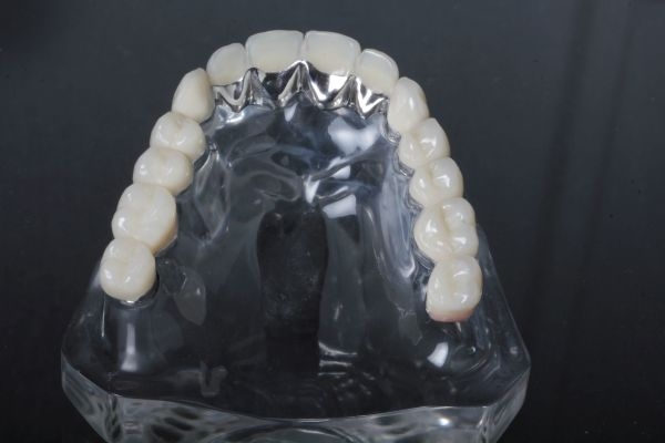 Titanium veneer crown Upper jaw non visible area with partial ceramic veneer