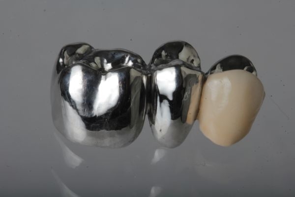 Non-precious metal veneer crown Upper jaw non visible area with partial ceramic veneer