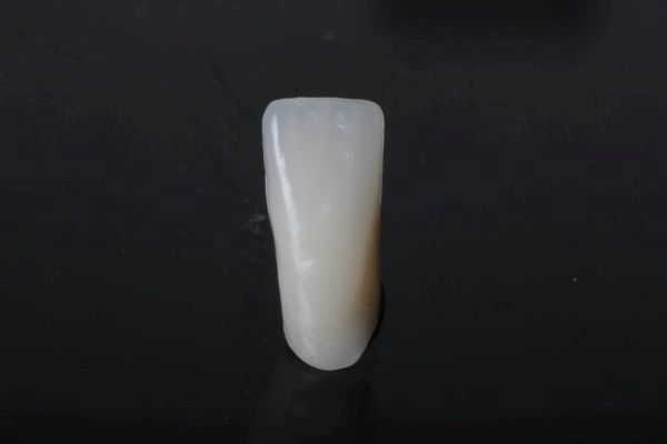 Vollkronen aus Keramik Material Celtra UK sichtbarer Bereich ohne Verblendung