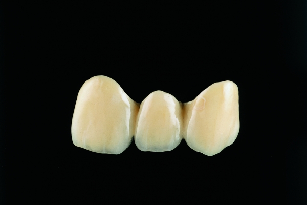 Metal-ceramic veneer crowns fully veneered in non-precious metal