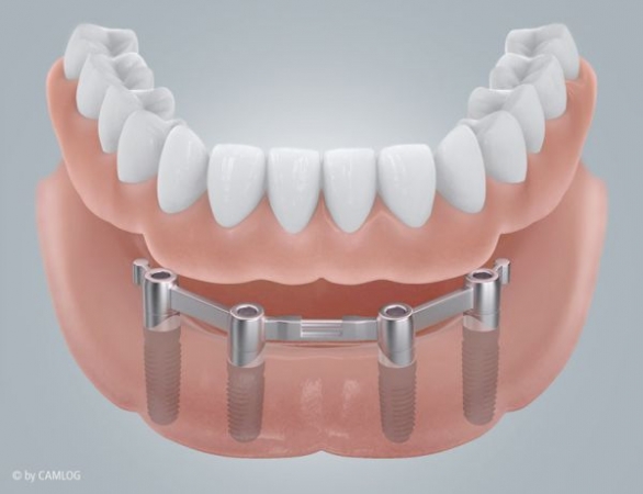 Implantat-Stegarbeit