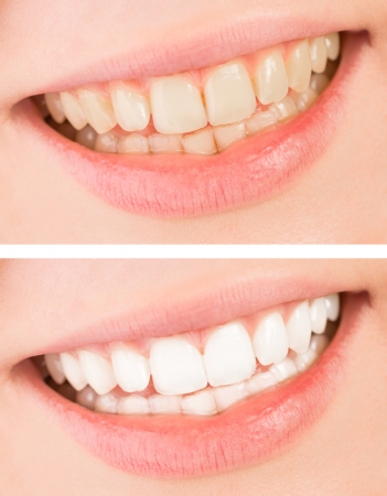 Weiße Zähne mit Home-Bleachingschienen