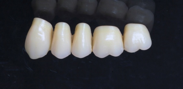 Bridge made of zirconium monochrome for 3 missing teeth side by side Upper jaw not visible area with 6 partial veneers