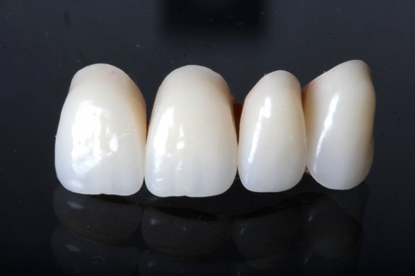 Bridge of non-precious metal for a double tooth gap