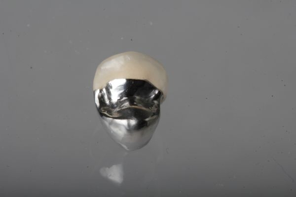 Titanium veneer crown Upper jaw non visible area with partial ceramic veneer