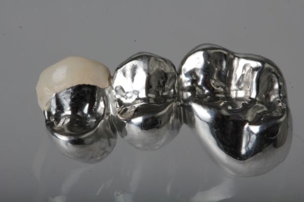 Non-precious metal veneer crown Upper jaw non visible area with partial ceramic veneer