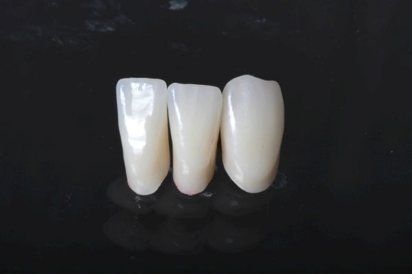 Bridge made of non-precious metal veneer, for a single tooth gap lower jaw visible area with partial ceramic veneer