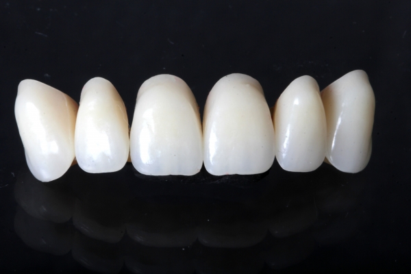 Bridge made of zirconium monochrome veneer, for 3 missing teeth side by side