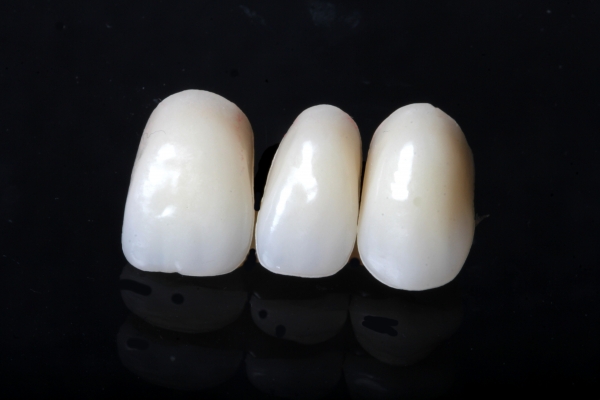 Zirconium bridge for a single tooth gap