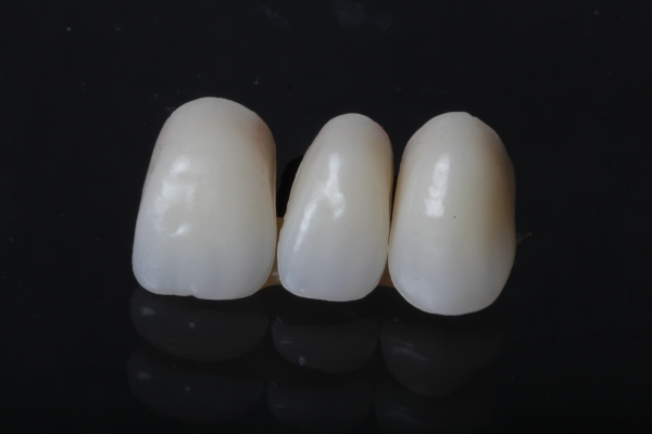 Bridge made of non-precious metal Non-precious metal for a single tooth gap with partial veneer