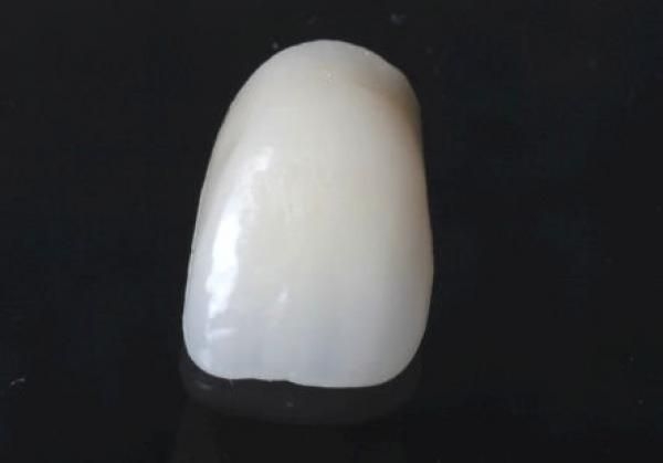 Gold veneer crown with partial ceramic veneer