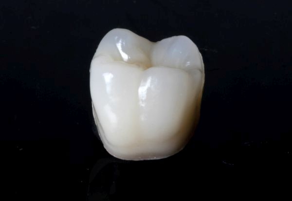 Hybrid ceramic crown for a single-tooth gap in the lower jaw invisible area