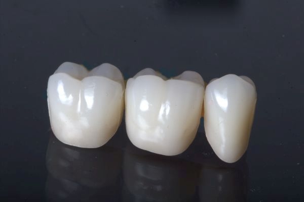 Bridge made of zirconium monochrome for a single-tooth gap lower jaw non-visible area with 3 partial veneers