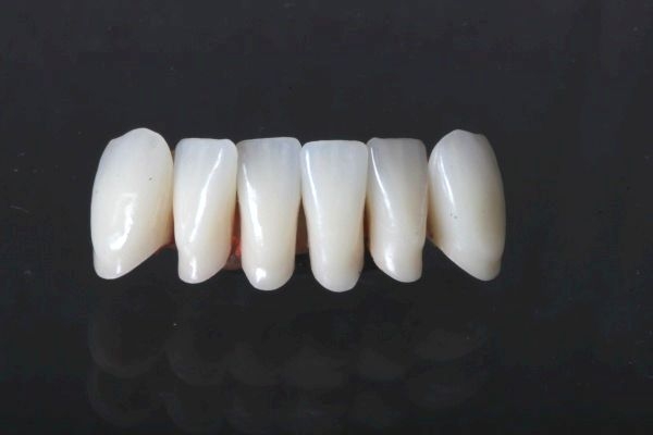 Bridge made of non-precious metal NEM for 3 missing teeth side by side lower jaw visible area with partial ceramic veneer